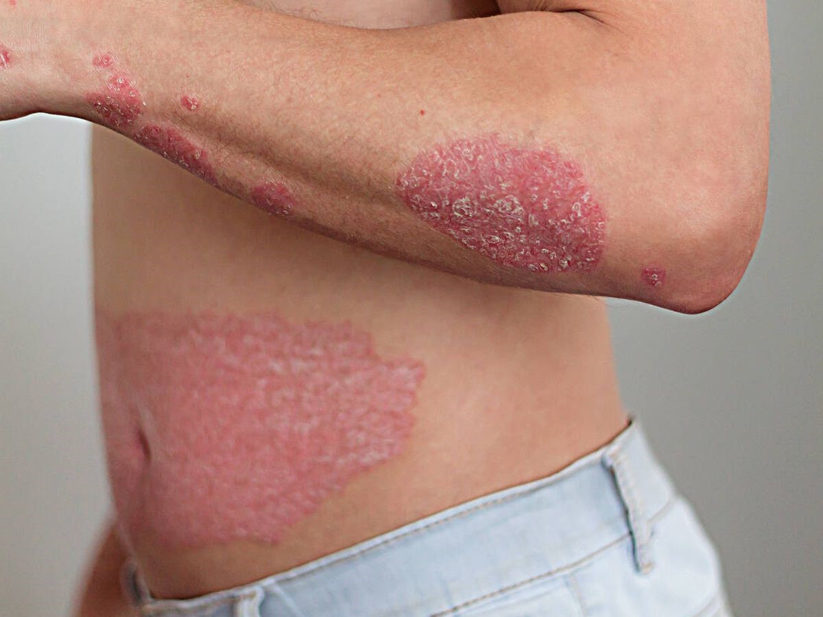 Si tienes psoriasis, no dejes de visitar a tu cardiólogo