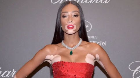 TODO LO QU NECESITAS SABER SOBRE EL VITILIGO