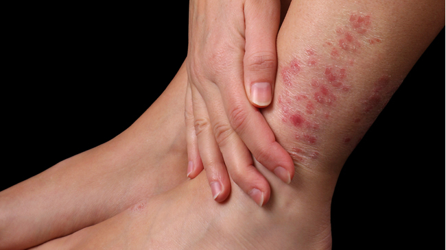 LO QUE NO SABÍAS DE LA PSORIASIS