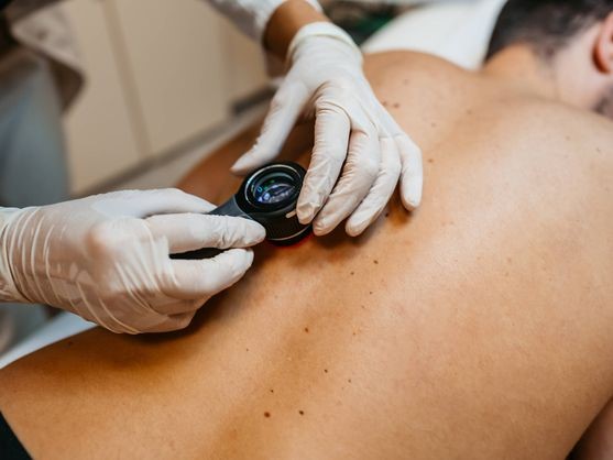 Que nadie fallezca de melanoma: decálogo sobre este tumor cada vez más frecuente