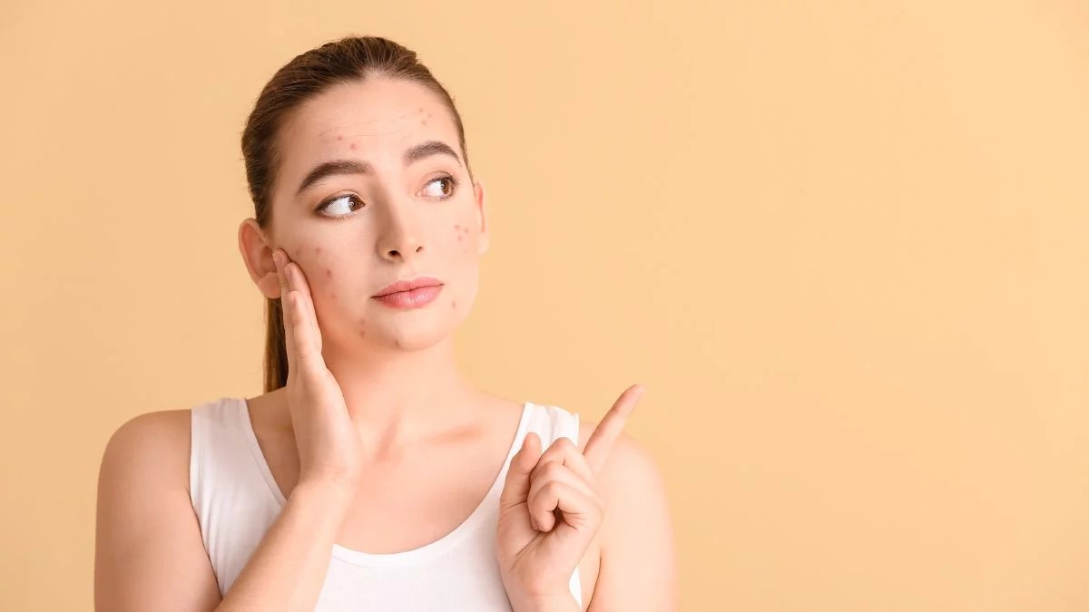 ¿Sabías que tu acné se podría curar sin medicación?