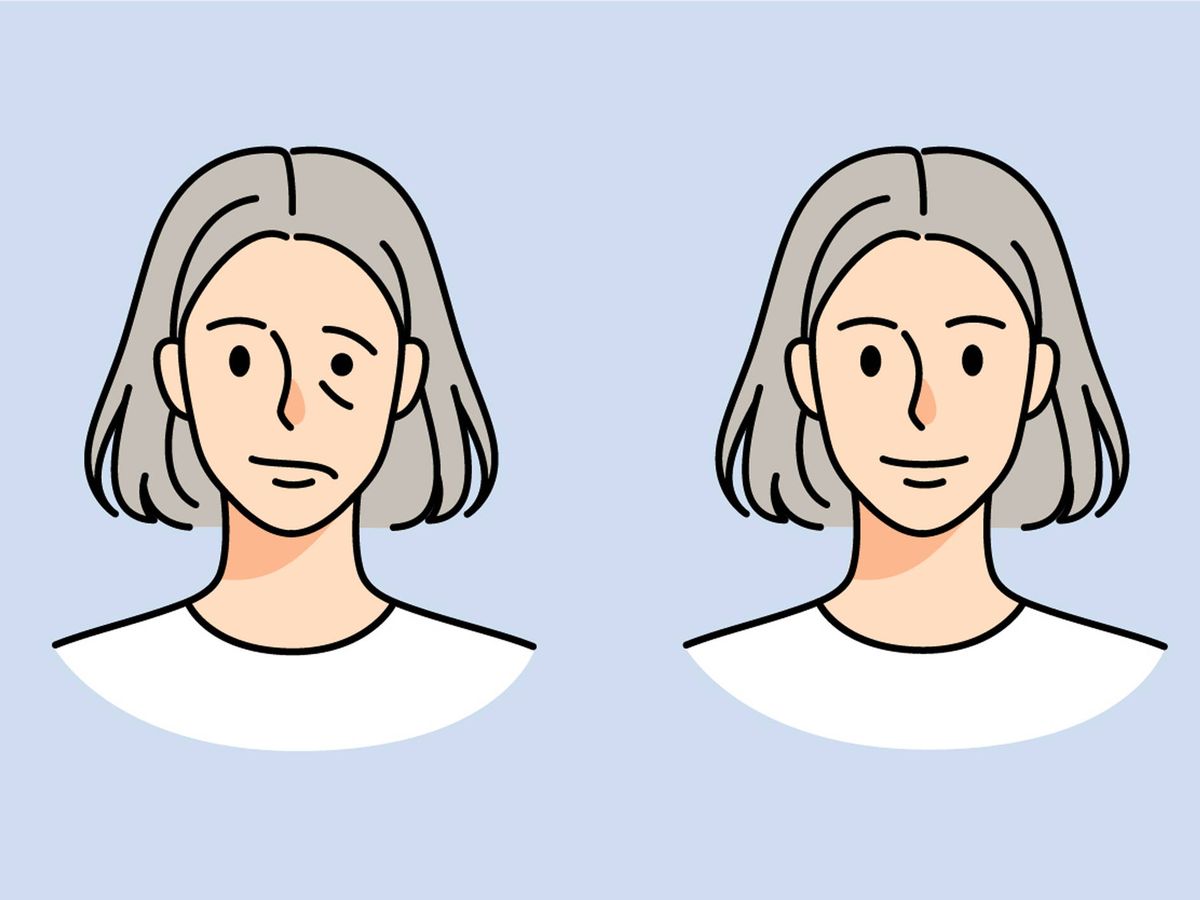 TODO LO QUE NECESITAS SABER SOBRE LA “PARALISIS FACIAL”