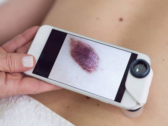 Los tres grandes avances que han llegado al manejo del cáncer de piel