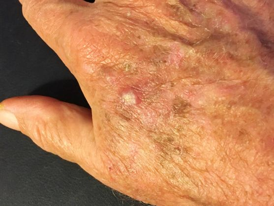 QUERATOSIS ACTÍNICAS: NUEVOS CONCEPTOS SOBRE EL PRECANCER DE PIEL MÁS FRECUENTE