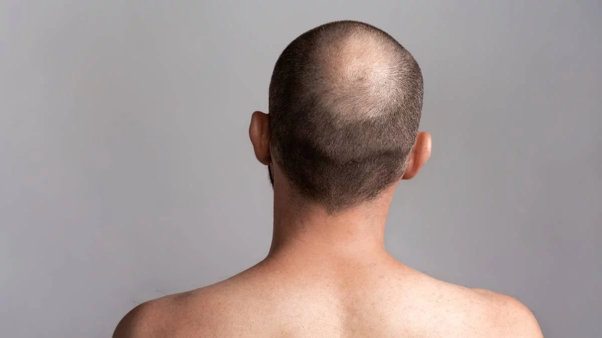 Trasplante de pelo largo: las 5 ventajas de esta técnica contra la calvicie.