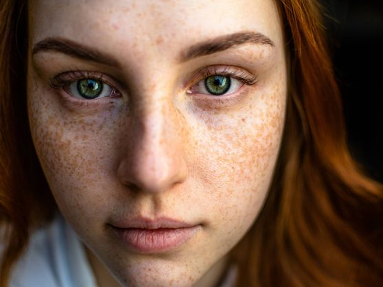 ¿Por qué conviene revisarse los lunares en primavera? La importancia del “skin check”.